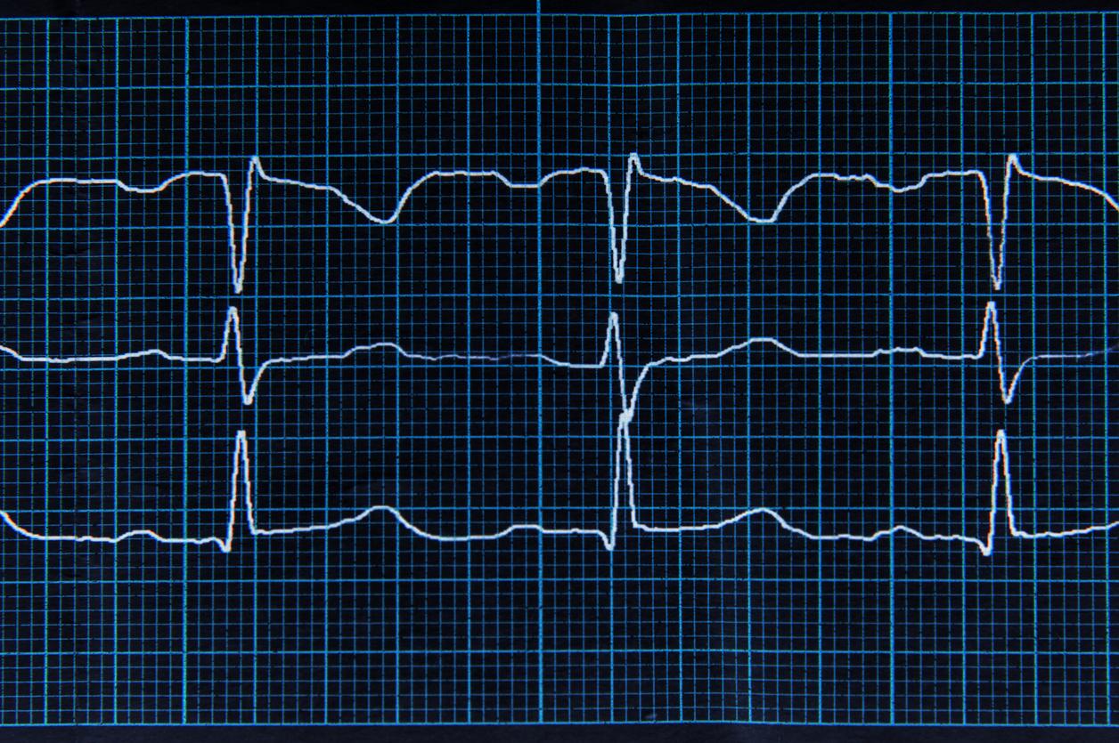 Fibrillation atriale : le choc électrique pour resynchroniser les cellules  cardiaques