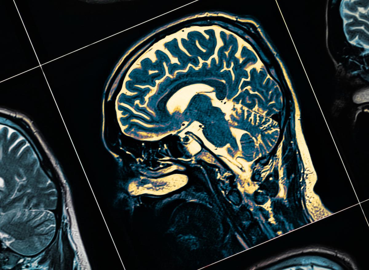 Traitement du glioblastome : un nouveau dispositif pour vaincre la barrière hématoencéphalique