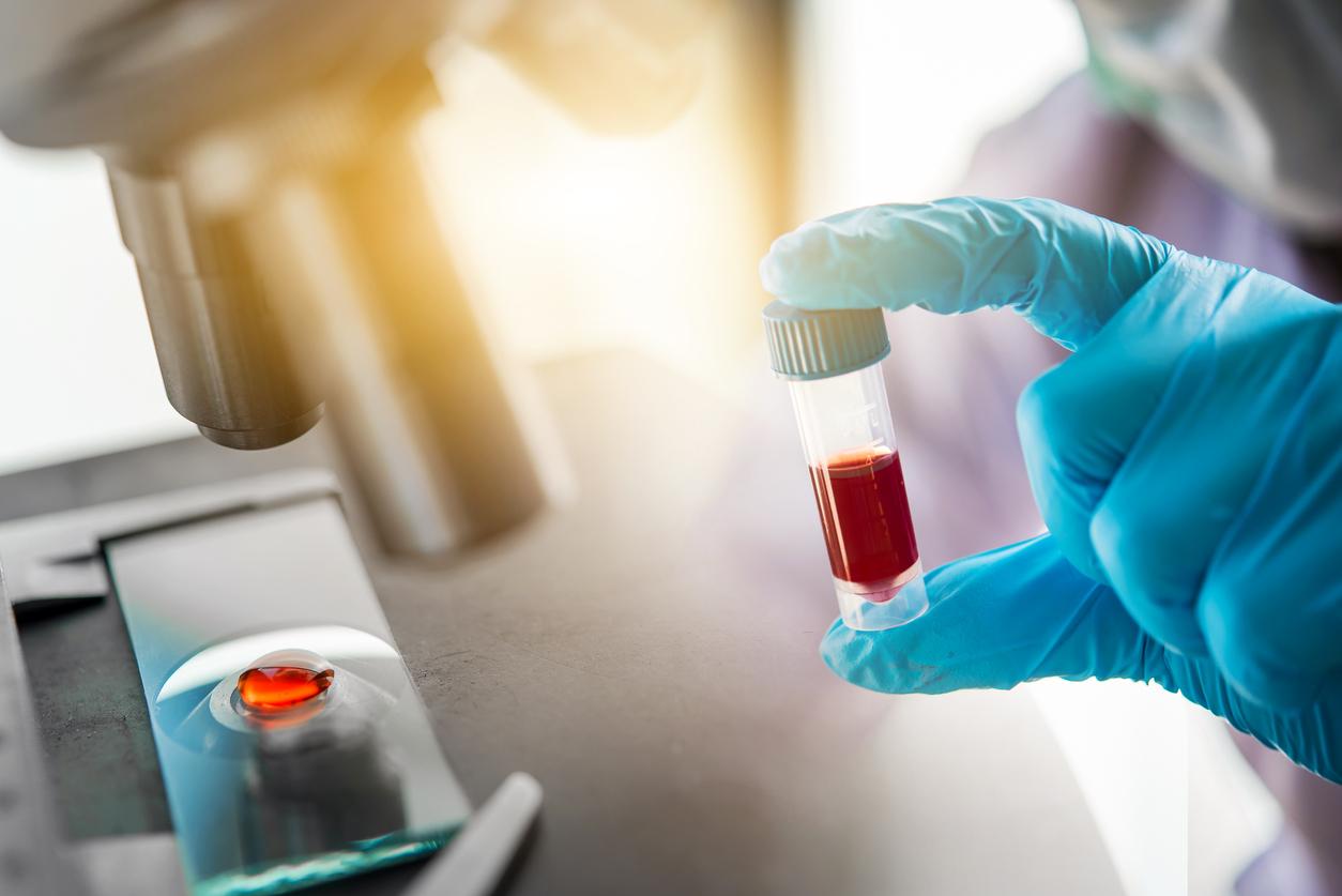 Blood test capable of detecting Alzheimer's disease at 91%