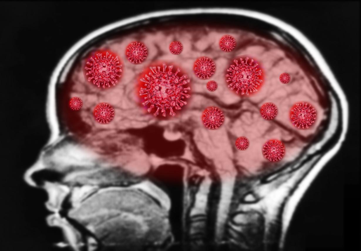 Covid-19: Infection causes loss of IQ points even in mild form