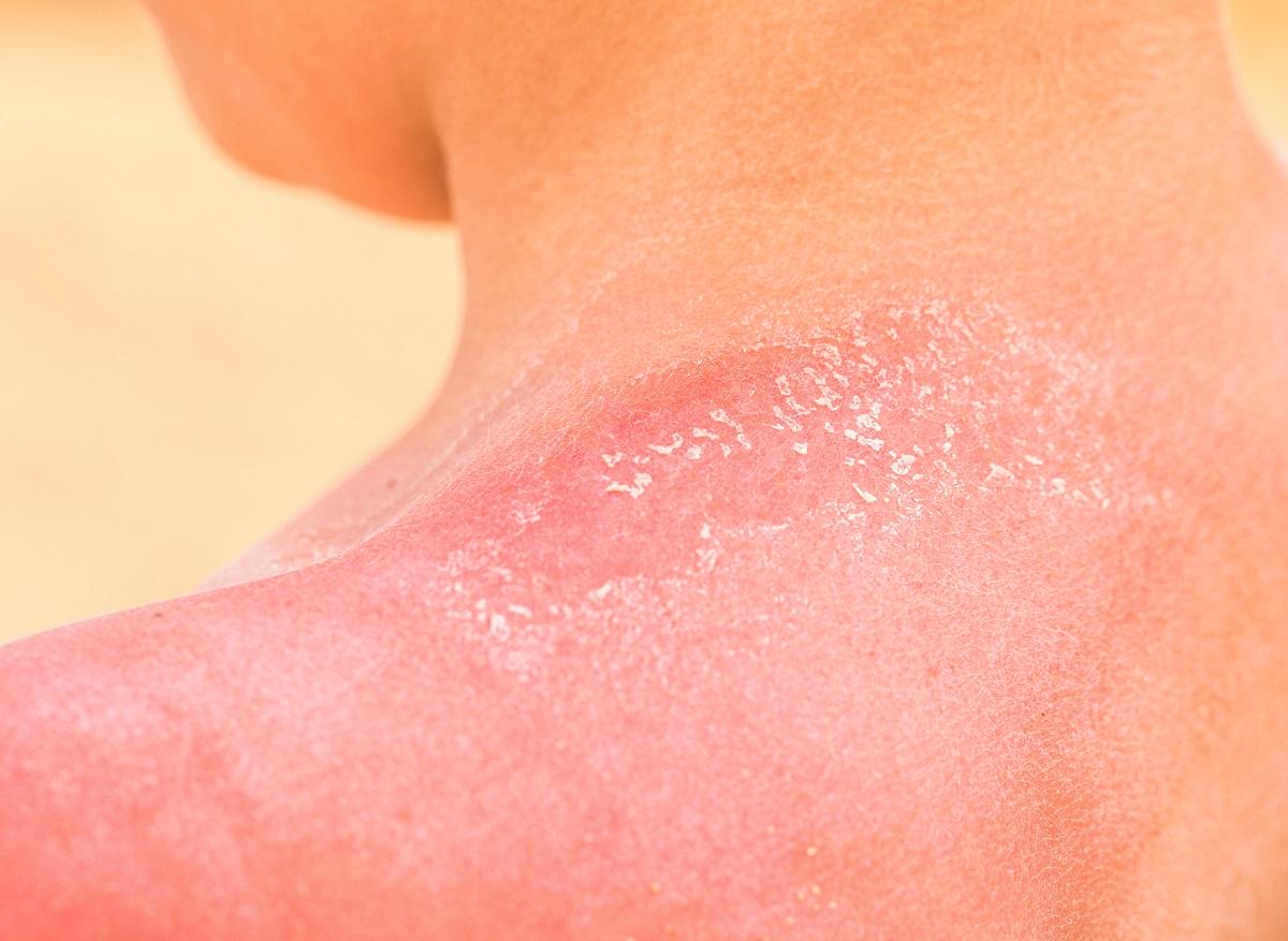 How can a sunburn get worse?