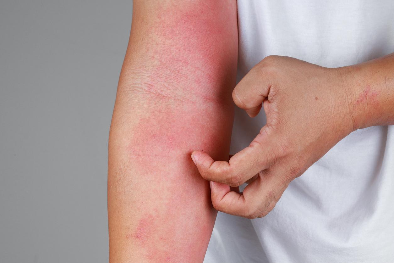 Eczema: this condiment would promote flare-ups