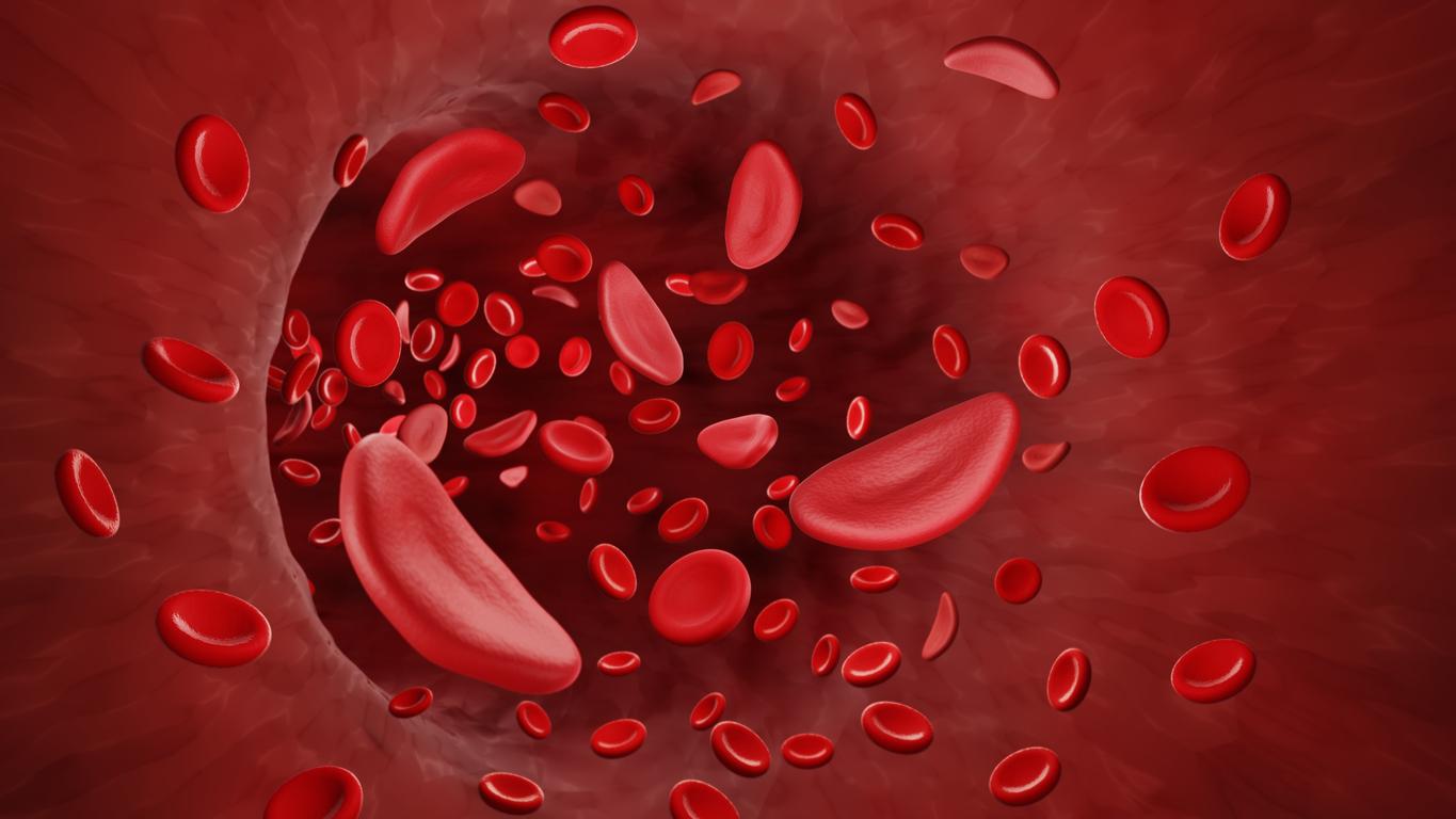 Sickle cell anemia: screening will be generalized to all newborns from November 1