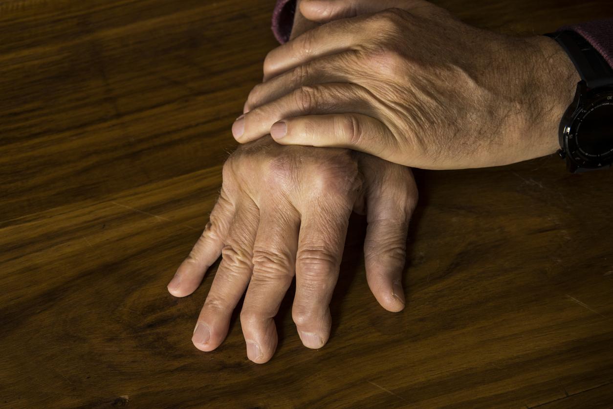 Psoriasis : un quart des patients ont aussi des problèmes d’arthrite 