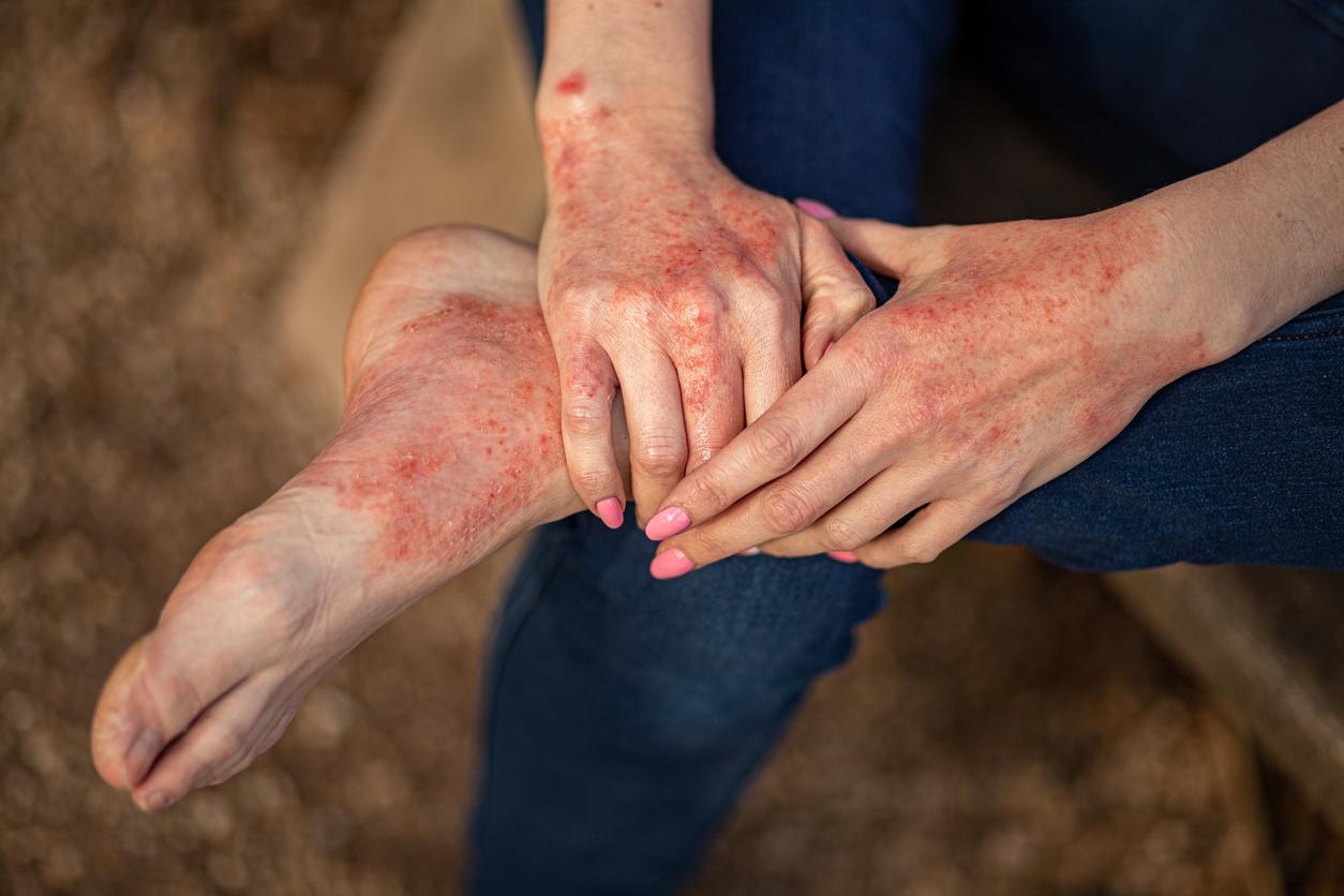 Psoriasis : la pollution de l'air peut favoriser son apparition