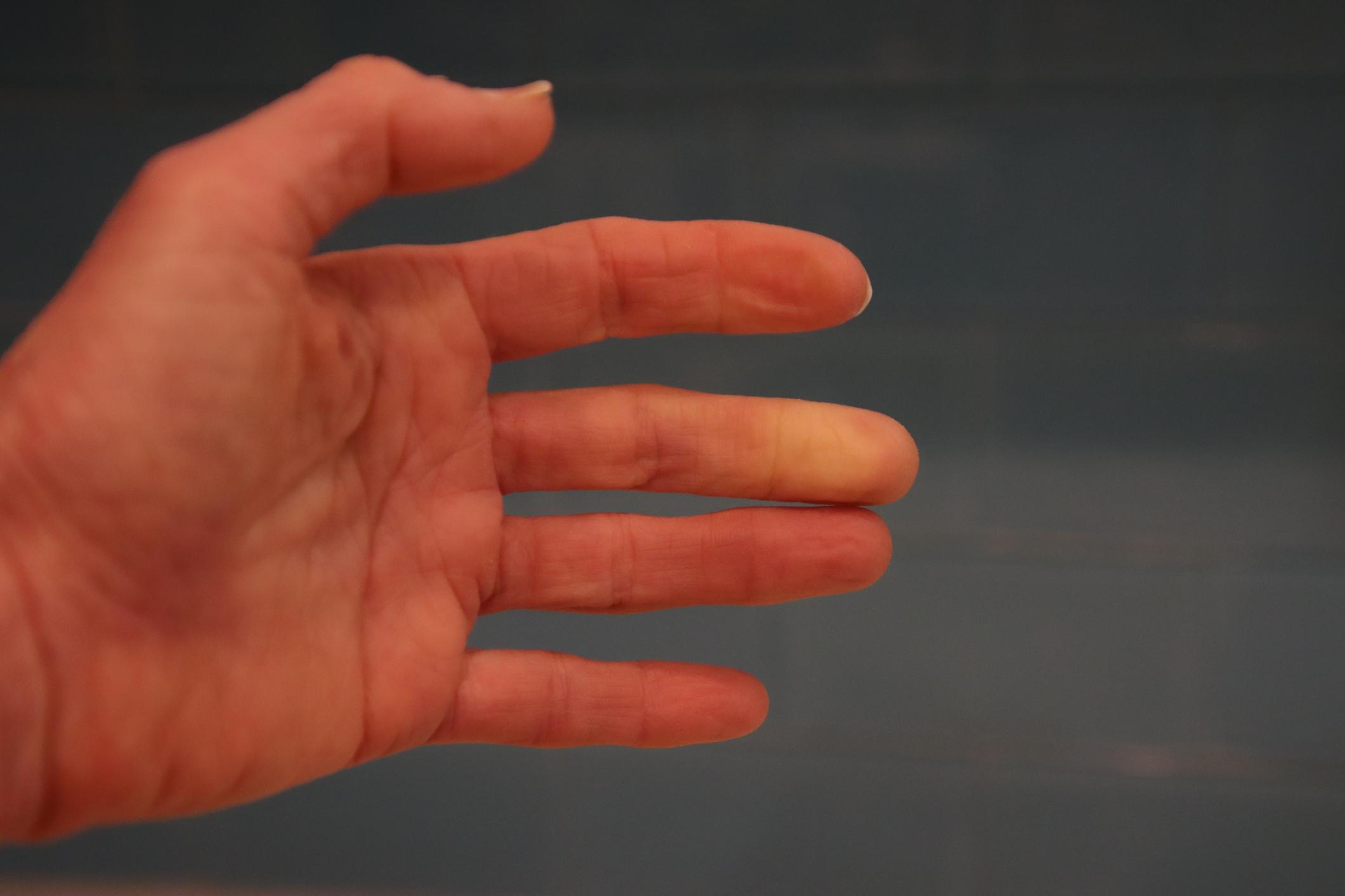 Vous avez les mains froides ? Ce test d'une minute vous dira si vous souffrez du syndrome de Raynaud