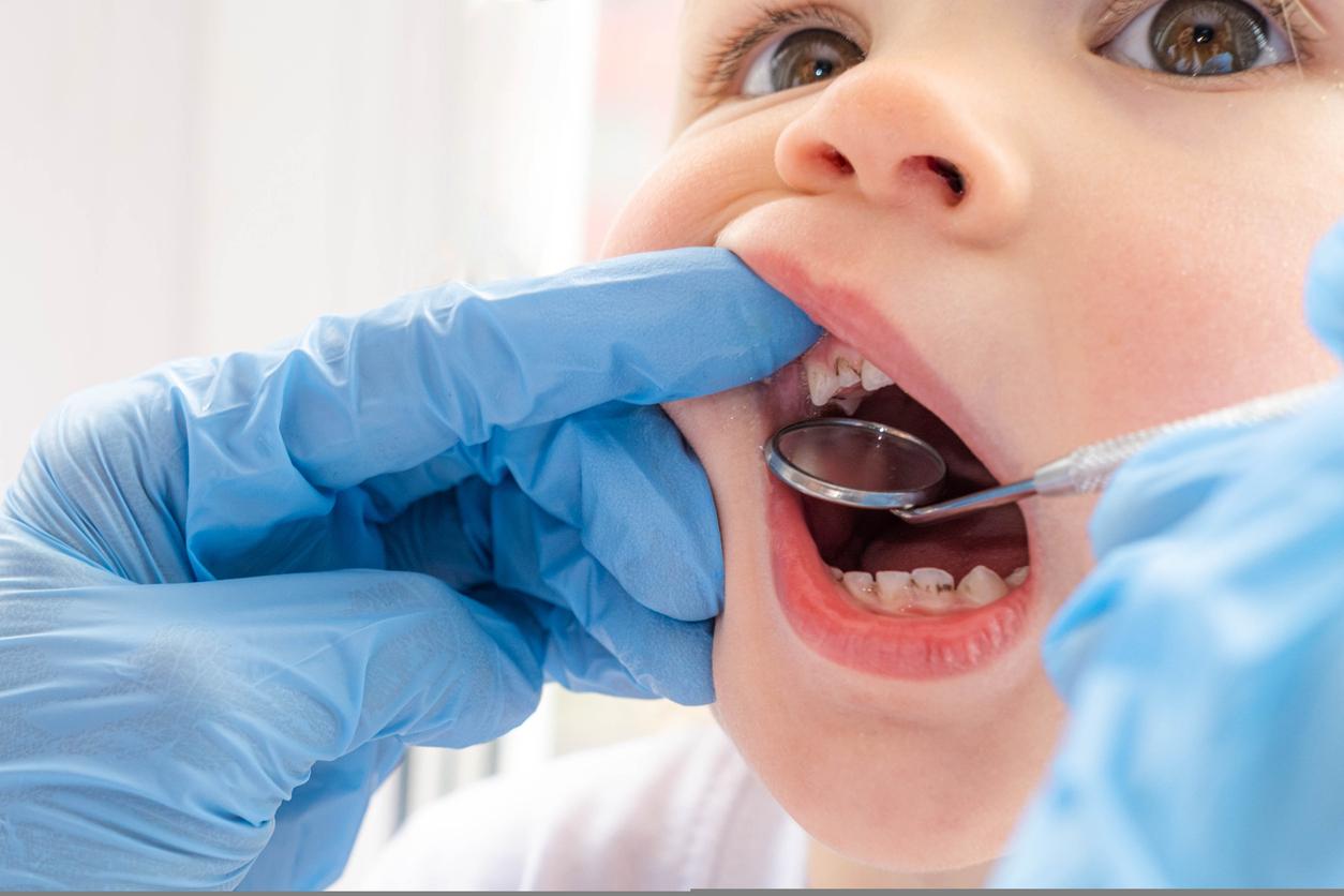 Cavities: fluoride varnishes soon to be reimbursed for children aged one and over 