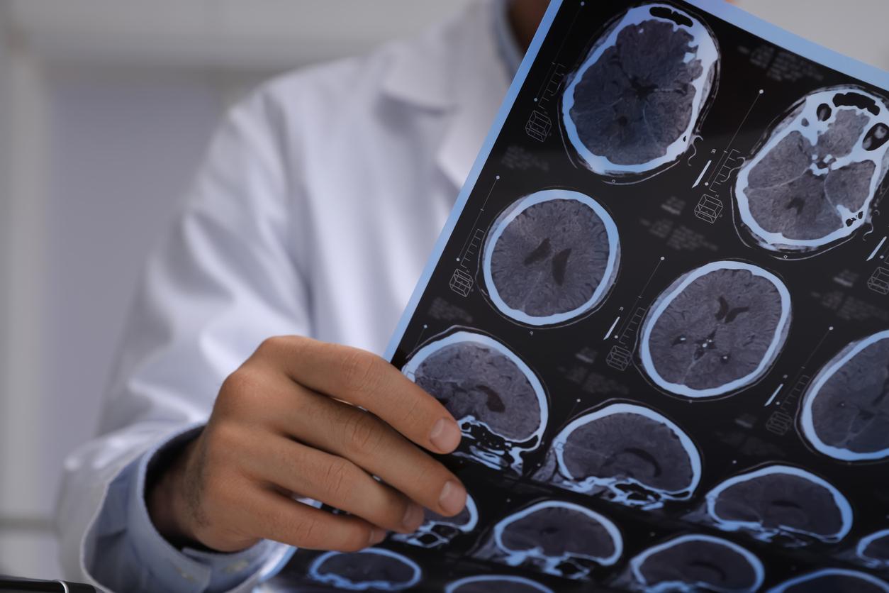 Concussions increase risk of dementia as you age 