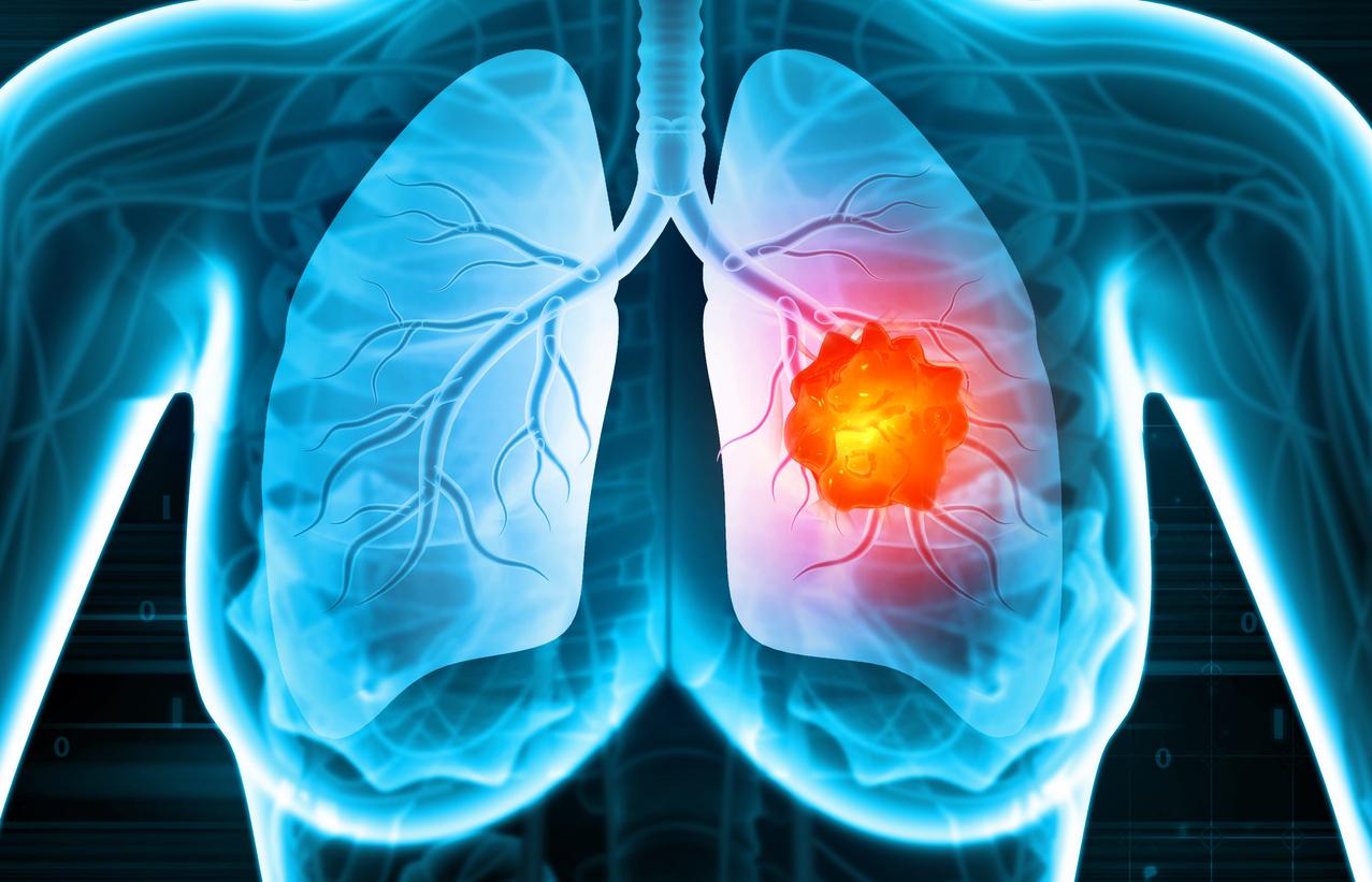 Small cell lung cancer: immunotherapy increases chances of survival
