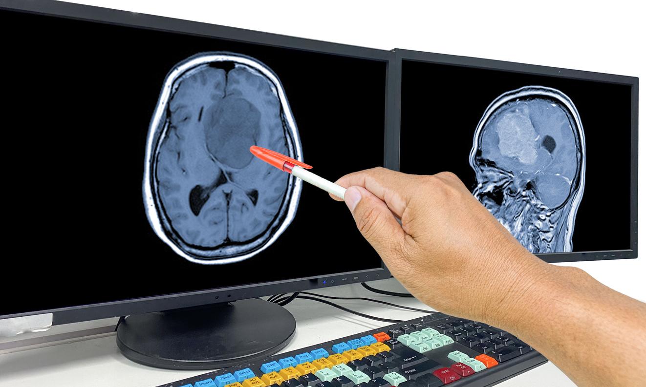 Androcur and meningioma: under what conditions can macroprogestins be taken?