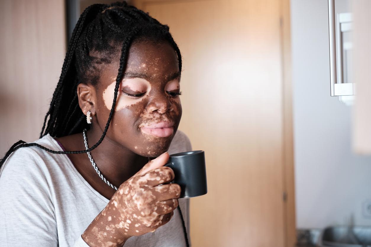 Ce médicament contre le vitiligo est disponible dans toutes les pharmacies