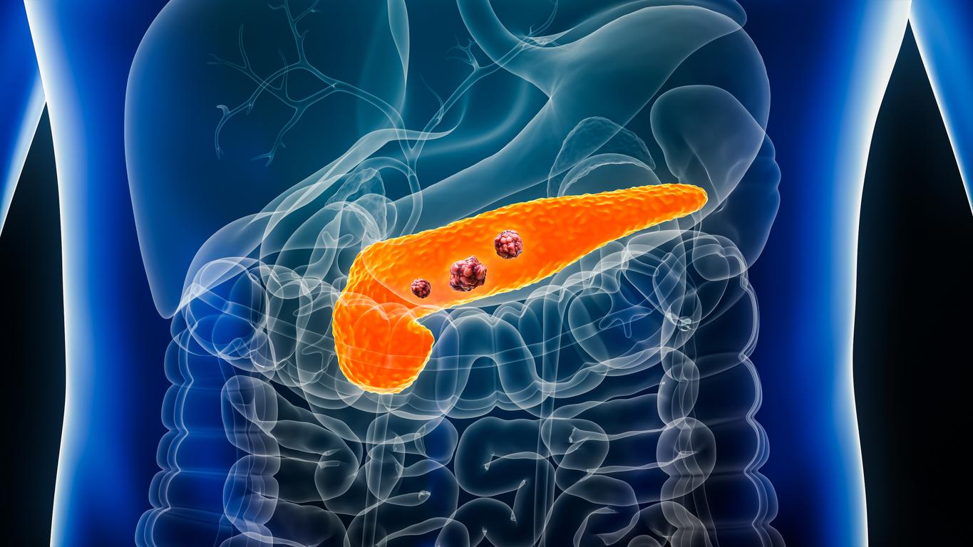 Cancer du pancréas : comment les cellules cancéreuses se passent de sucre