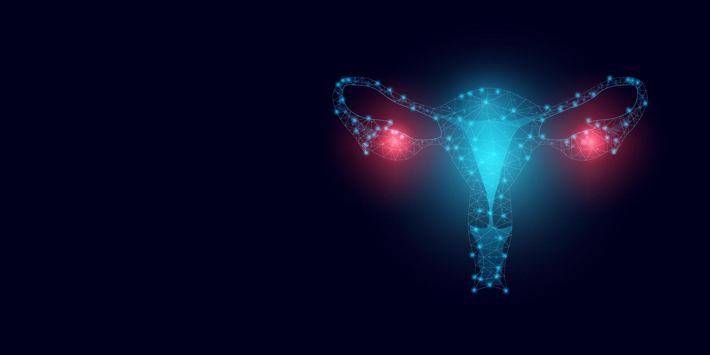 Endometriosis: patients are 4 times more at risk of ovarian cancer