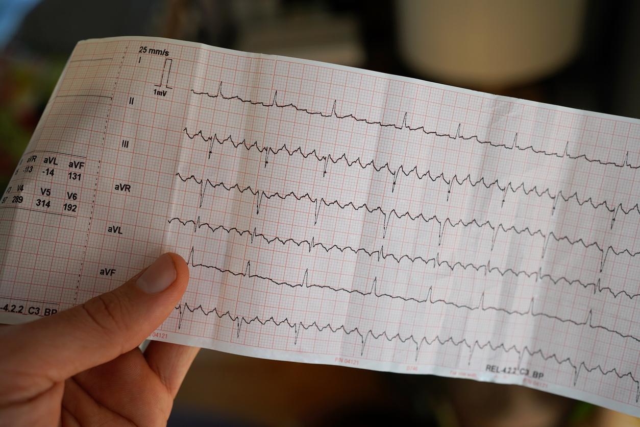 Atrial fibrillation: irregular heartbeats \