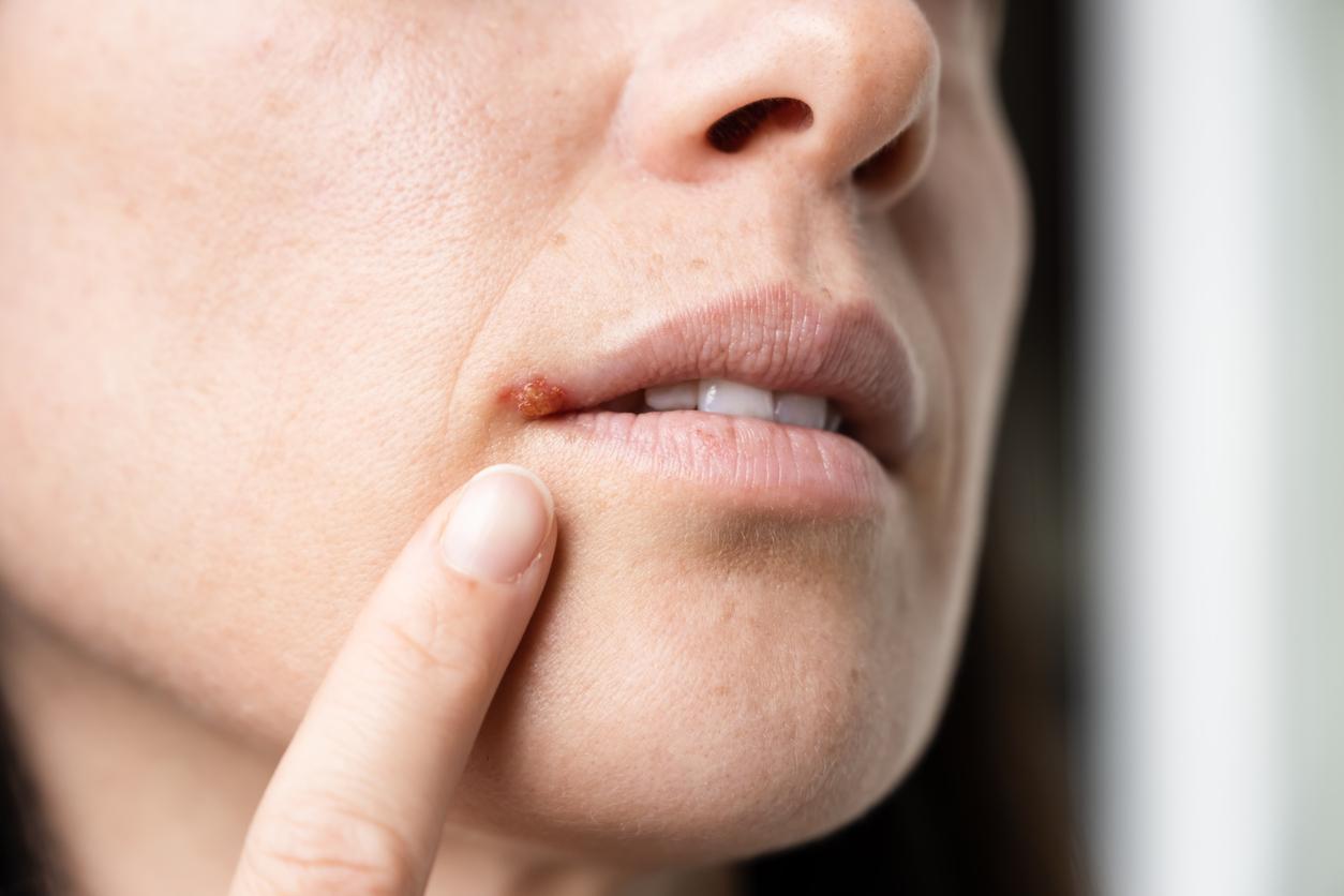 Herpes labialis: 5 things you should definitely not do when you have a cold sore