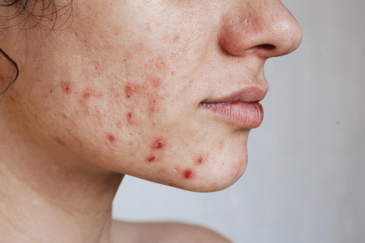 Acne: Omega-3 fatty acids reduce lesions