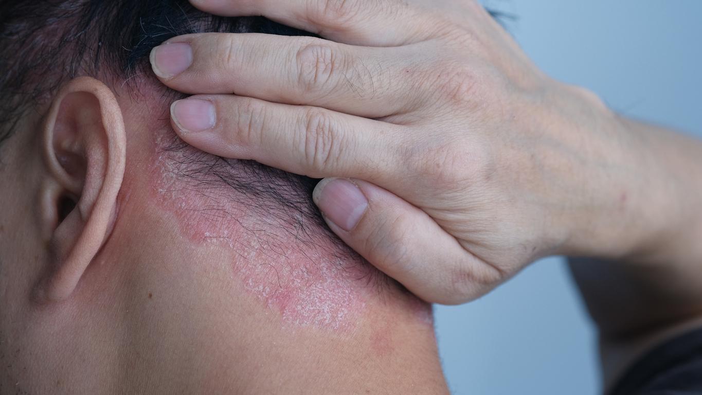 Psoriasis : un extrait végétal présenterait un potentiel thérapeutique 