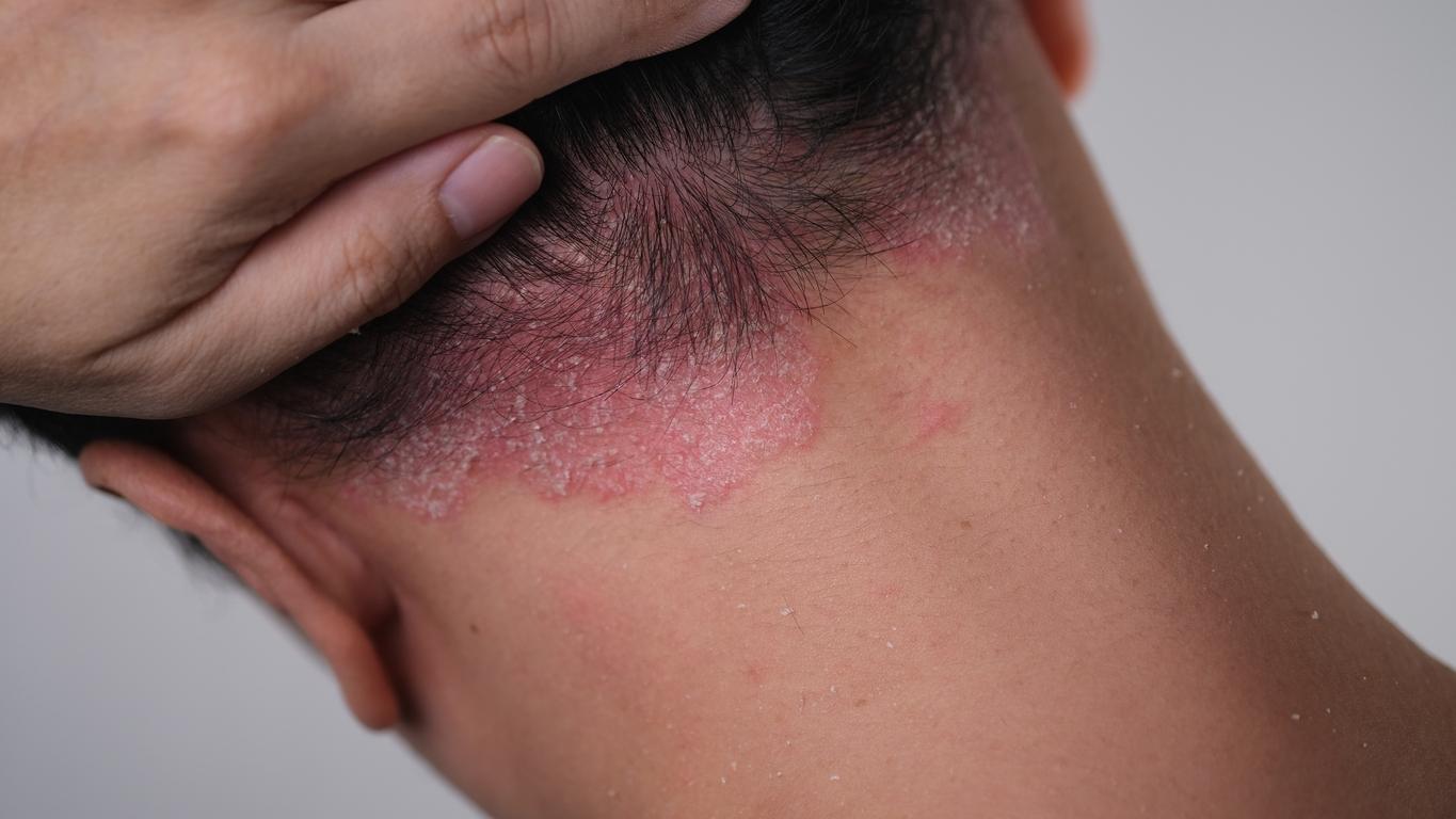 Une nouvelle cible dans le traitement du psoriasis