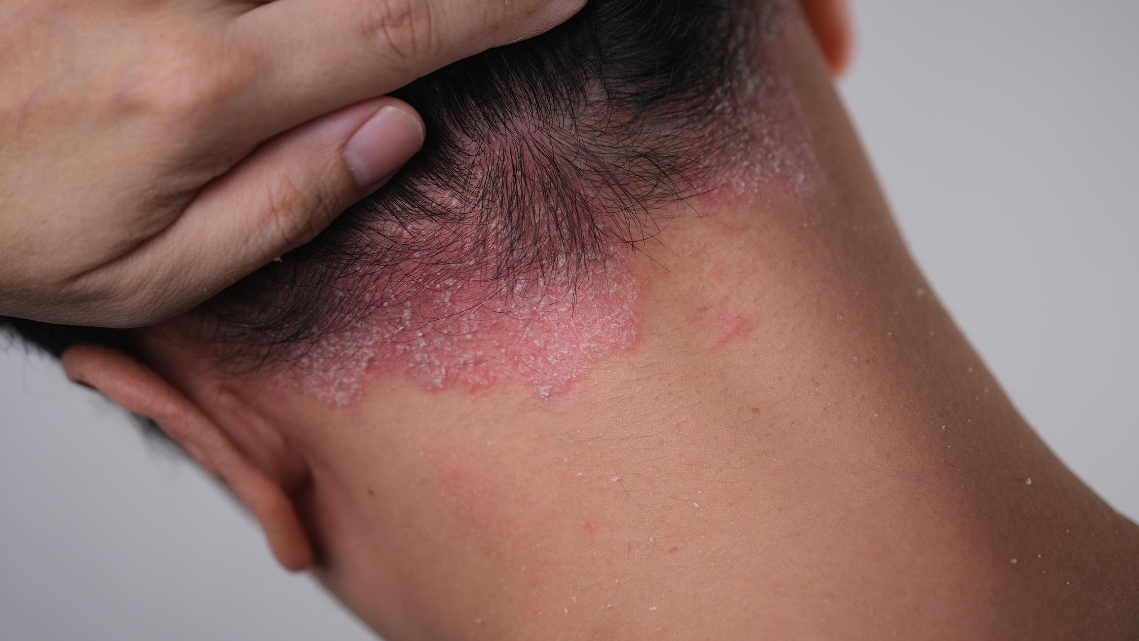 Psoriasis : la peau peut devenir plus saine grâce à un traitement à domicile plutôt qu'en cabinet 