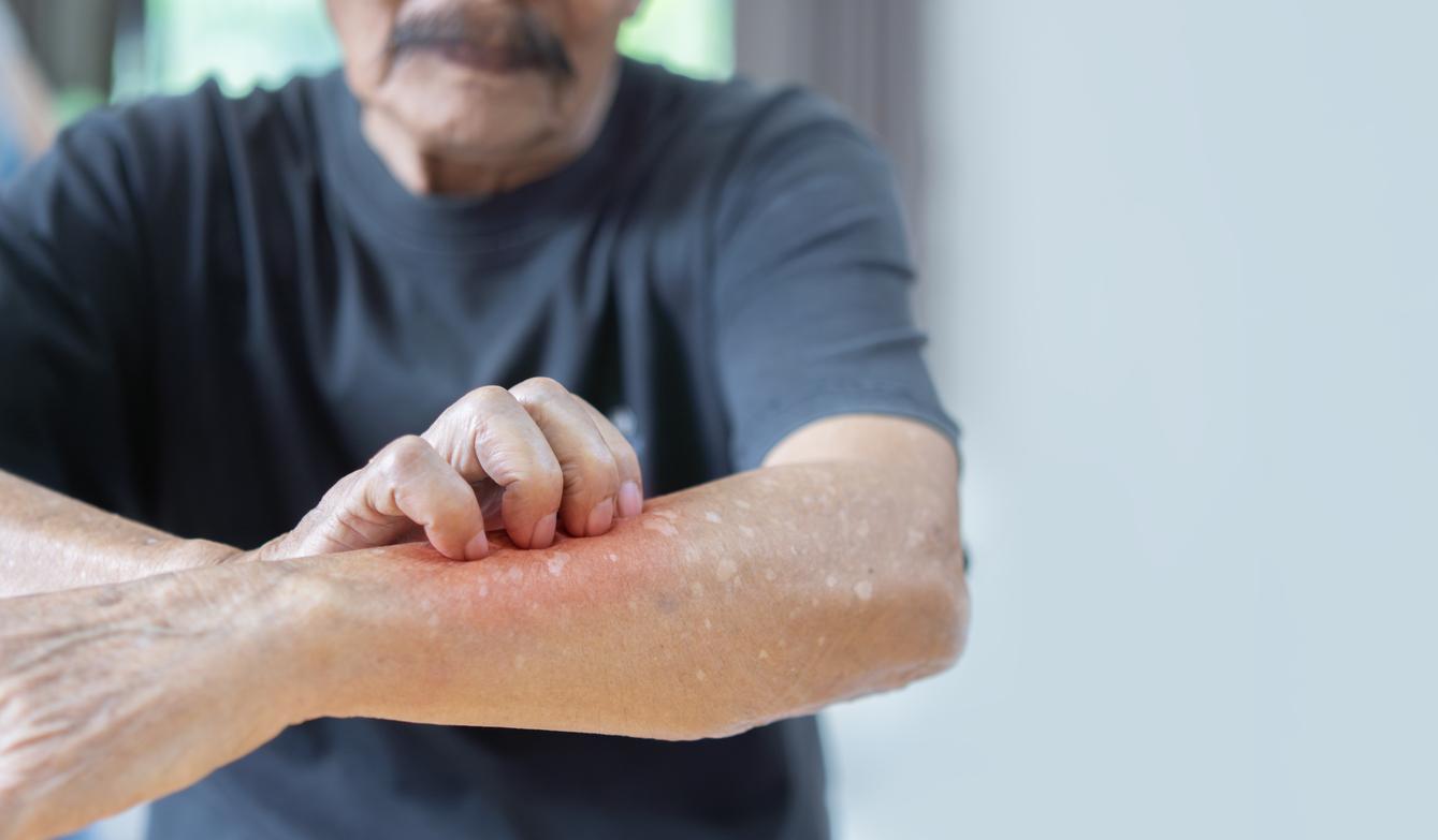 Eczema: antihypertensives increase the risk in the elderly