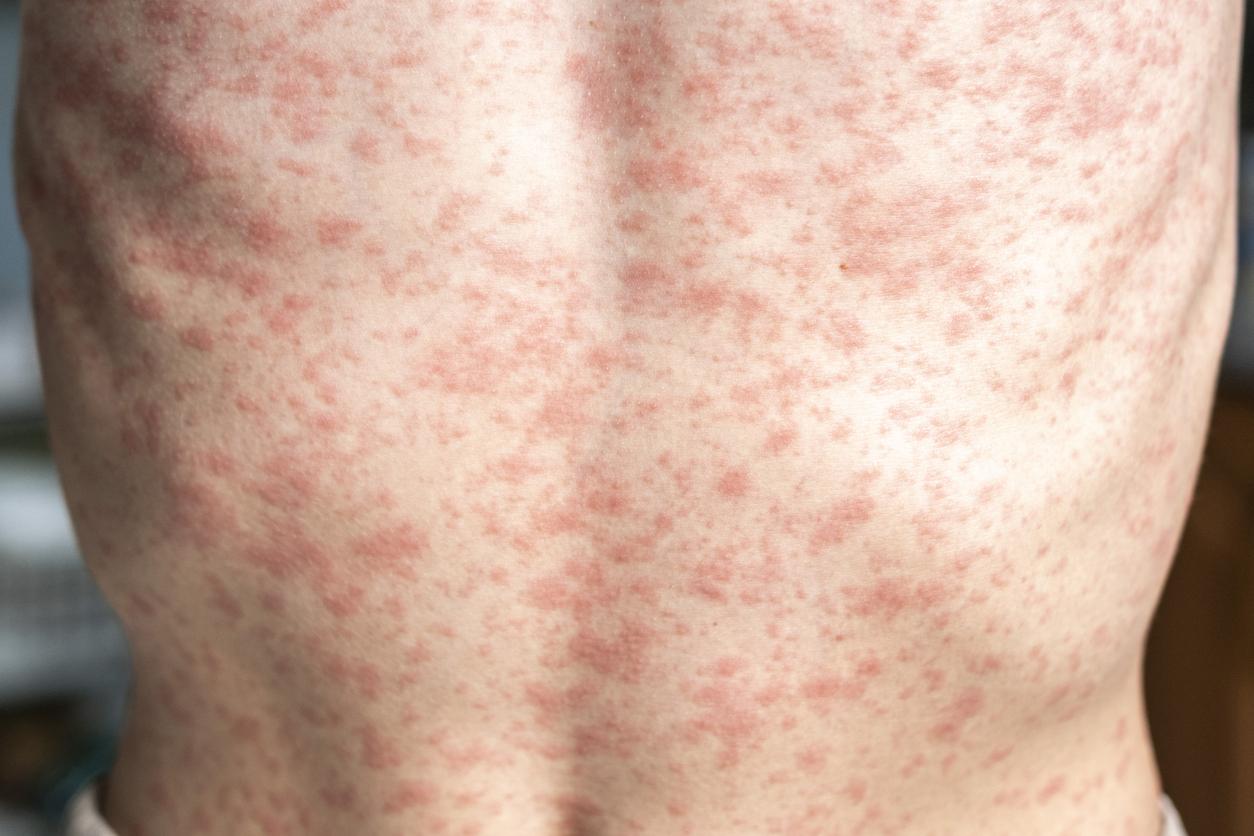 Increase in measles cases: how to recognize the pimples?