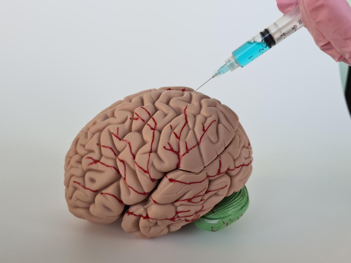 L’injection de dopamine directement dans le cerveau pour traiter Parkinson