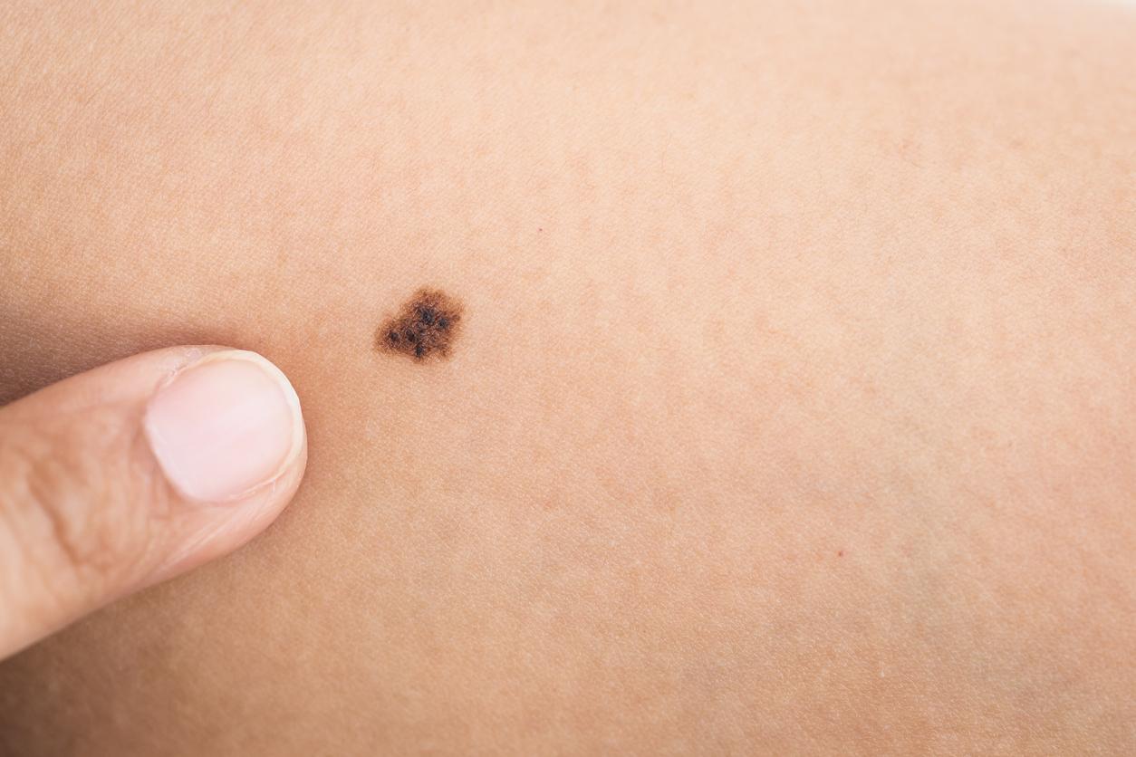 Melanoma: microneedle patch allows early detection