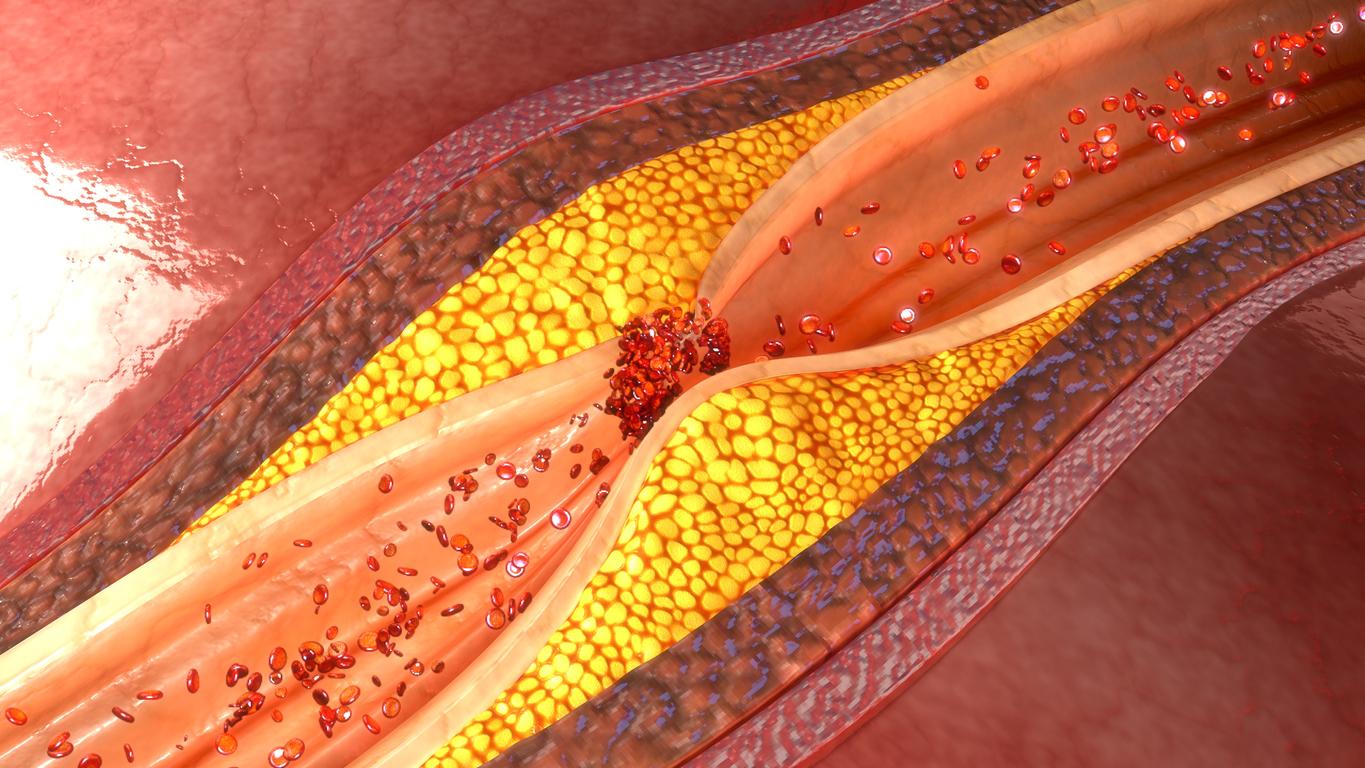 Près de la moitié des plus de 40 ans souffre de cette maladie cardiaque sans le savoir