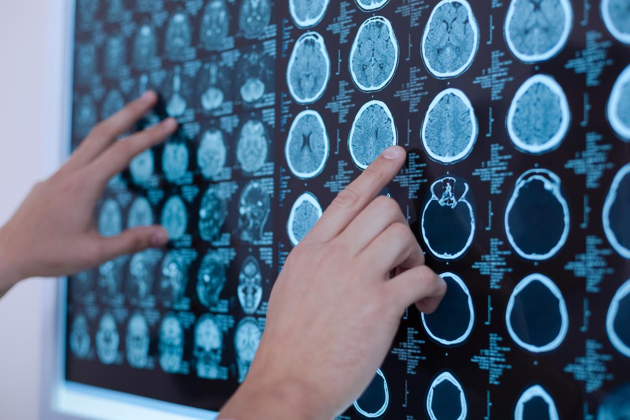 Some brain tumors could be linked to head trauma