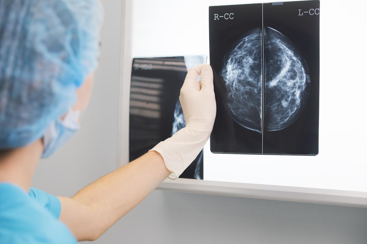 Cancer du sein triple négatif : une nouvelle cible thérapeutique découverte