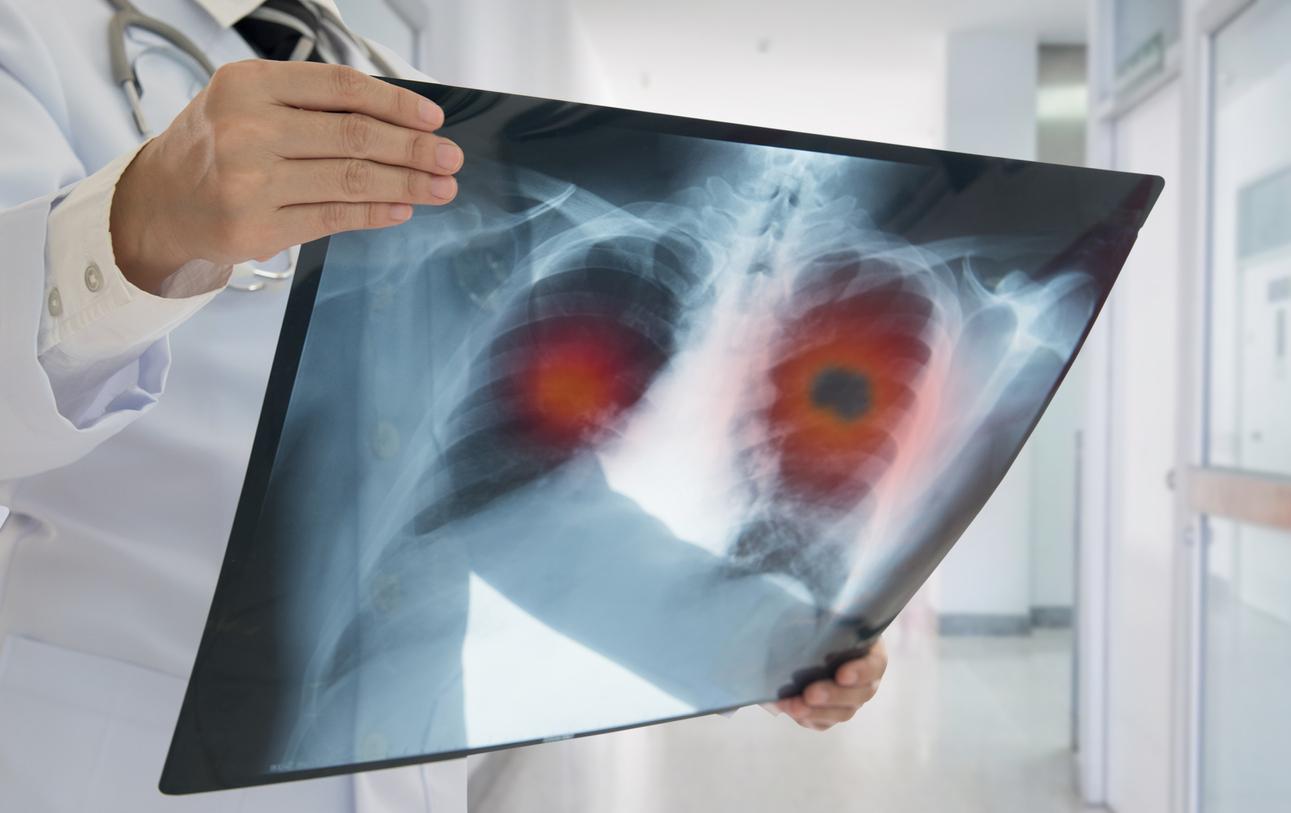 Lung cancer: here are the most common symptoms 