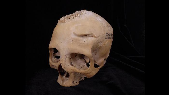 Cancer: 4,000-year-old Egyptian skull reveals treatment attempts