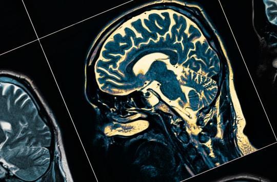 Parkinson : l'attaque auto-immune des malades pourrait commencer des années avant le diagnostic 