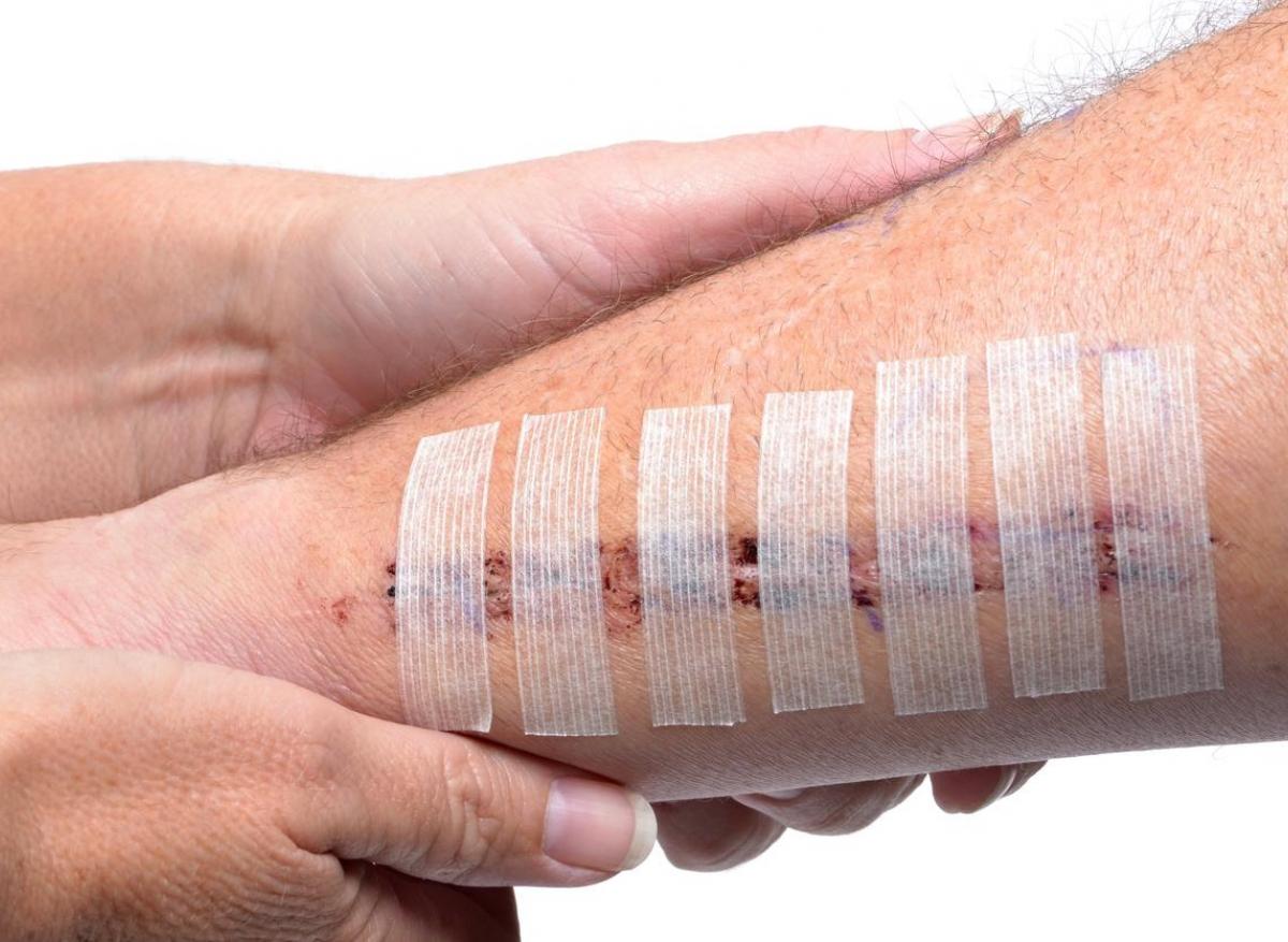 Pansement siliconé : une bonne idée pour ma cicatrice ? 