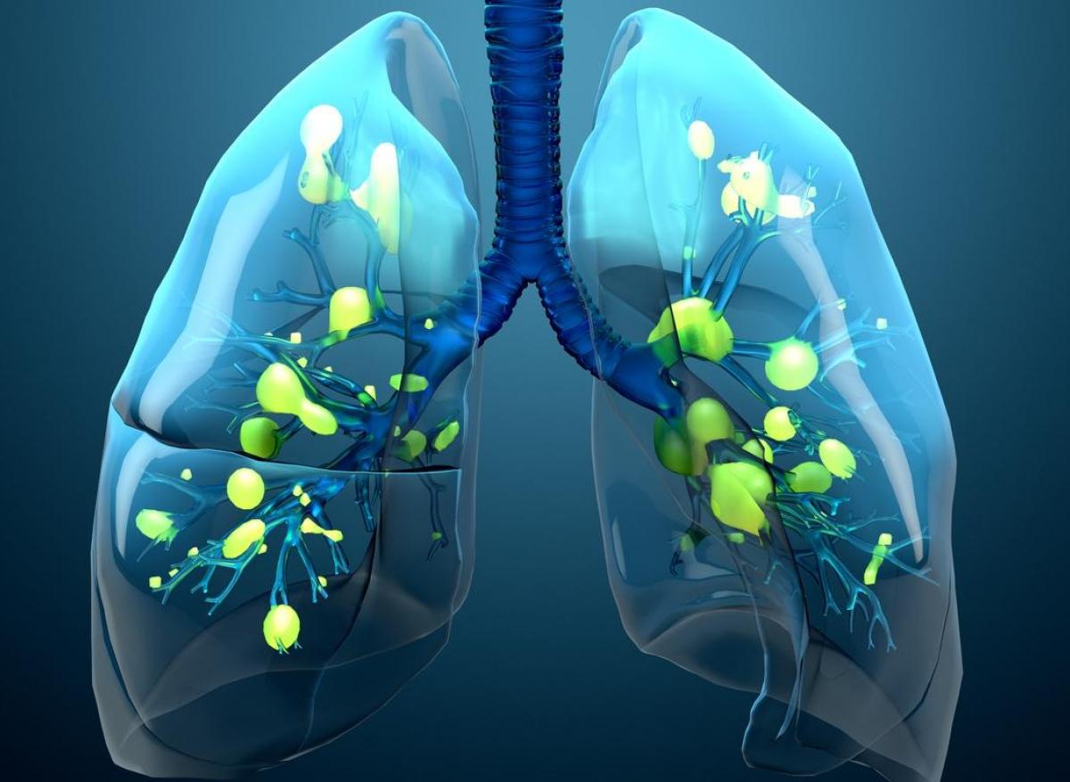 mucus de pneumonie