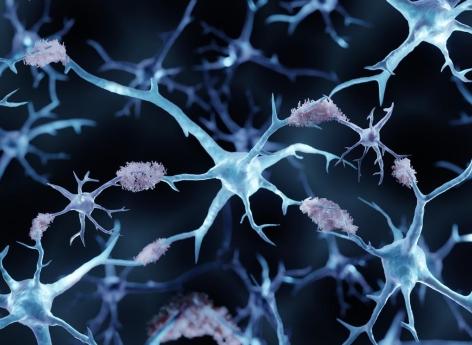 Maladie d'Alzheimer : l'espoir d'un traitement grâce à une protéine protectrice du cerveau