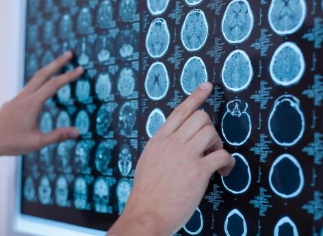 Dépression : les perceptions négatives liées à un dysfonctionnement de neurones de l’amygdale