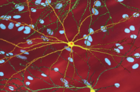 La chorée de Huntington, le terrible diagnostic 