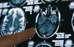 Alzheimer : une mauvaise oxygénation du cerveau en cause ?