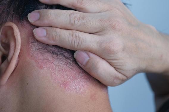 Psoriasis : un extrait végétal présenterait un potentiel thérapeutique 