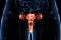 Traitement du cancer de l’ovaire : quels sont les 3 principaux moteurs du progrès ?