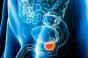 Cancer de la prostate : un colorant lumineux pour aider les chirurgiens à l’éradiquer