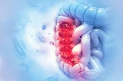 Cancer colorectal : les métastases se répandent avant que la tumeur ne soit détectable