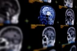 Anévrisme cérébral : peut-on en repérer les signes avant la rupture ?