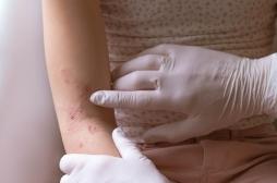 Vous avez vécu des événements stressants petit ? Votre eczéma risque d’être plus grave