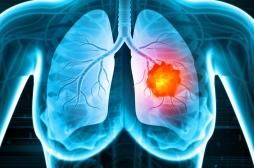 Cancer du poumon à petites cellules : une immunothérapie augmente les chances de survie