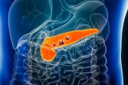 Cancer du pancréas : comment les cellules cancéreuses se passent de sucre