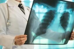 Cancer du poumon : pourquoi le traitement ne fonctionne pas sur certains patients ? 