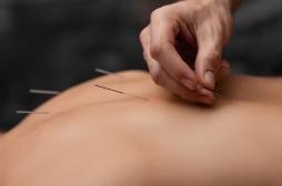 L'acupuncture réduit la douleur de la sciatique chronique due à une hernie discale