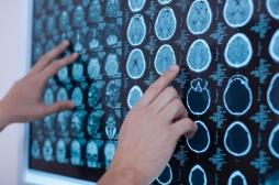 Certaines tumeurs cérébrales pourraient être liées à un traumatisme crânien